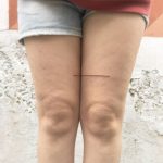 Lines on thighs